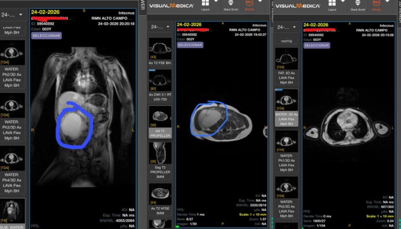 Elías tiene 3 años, una masa en el abdomen que no para de crecer y un medicamento que la provincia no entrega