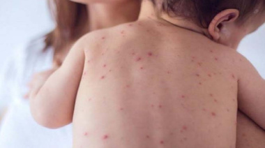 Río Negro refuerza la vigilancia epidemiológica tras confirmarse cuatro casos de sarampión de personas que pasaron por Argentina
