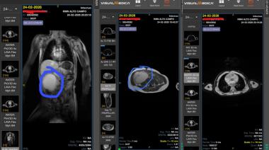 Elías tiene 3 años, una masa en el abdomen que no para de crecer y un medicamento que la provincia no entrega